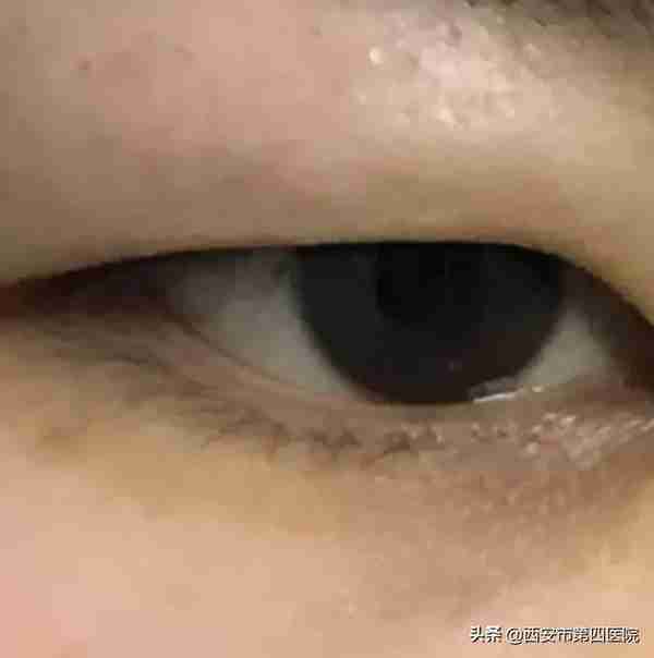 #安心变美课堂##我的安心变美推荐#眼皮松了,做提眉好还是双眼皮好
