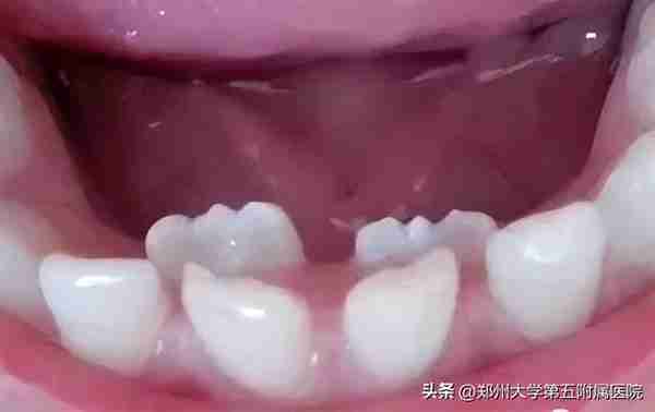 儿童换牙学问大,这些知识点请各位家长牢记