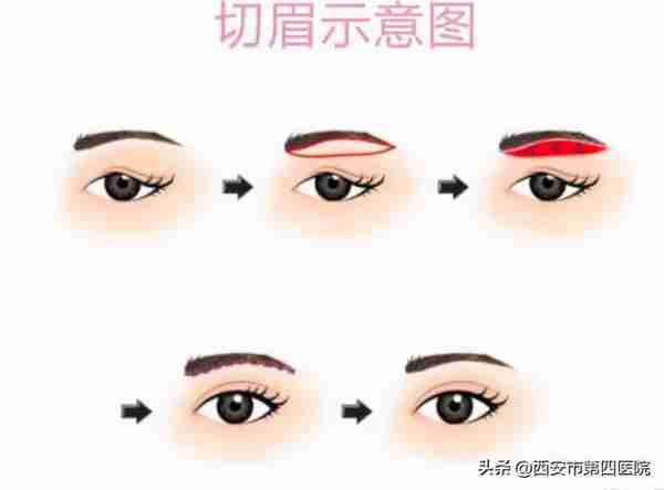 #安心变美课堂##我的安心变美推荐#眼皮松了,做提眉好还是双眼皮好