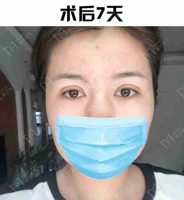 河南姑娘内双肿眼泡明显,我是如何给她设计自然款双眼皮的