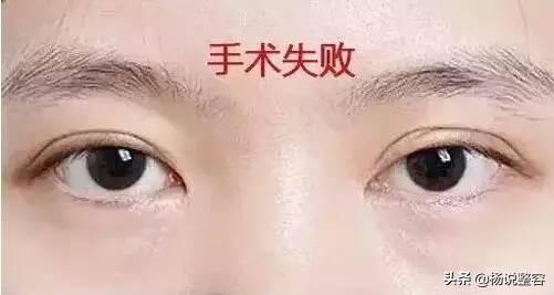 全切双眼皮不是说是永久的吗?为啥会消失呢?