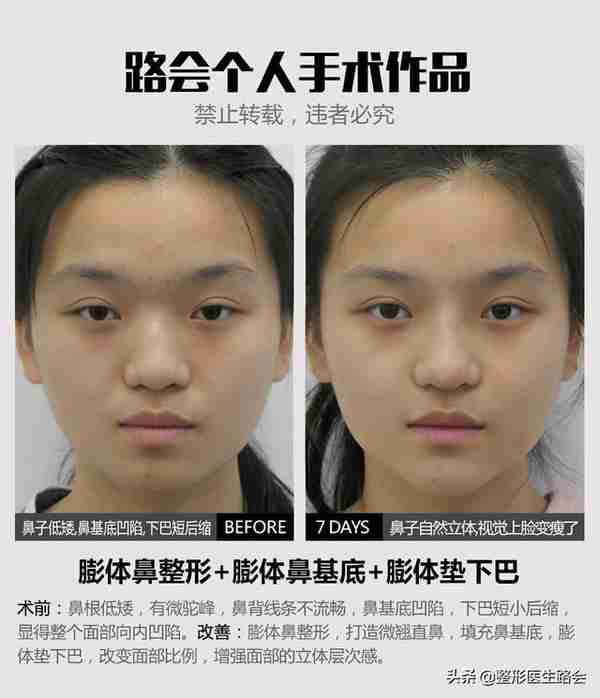 网上大热的肋骨鼻到底怎么样?取肋软骨会对身体有影响吗?