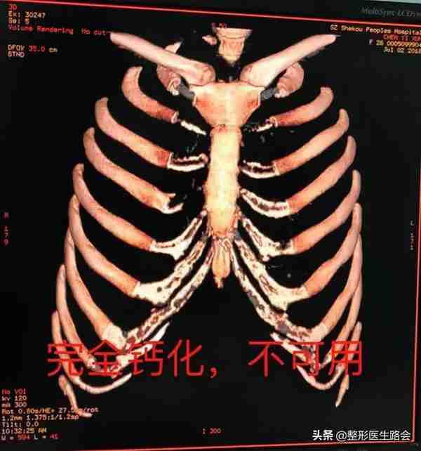 网上大热的肋骨鼻到底怎么样?取肋软骨会对身体有影响吗?