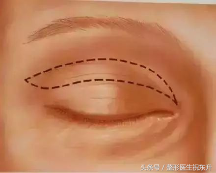 想做全切双眼皮,又担心不安全,有没有人可以给点真实性的建议?