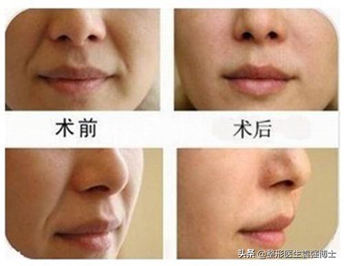 关于如何“消除”法令纹,整形医生有话说