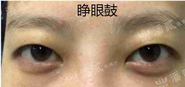 凸眼睛者:眼球突出、上睑凹陷或多层,双眼皮设计为何不宜过宽?