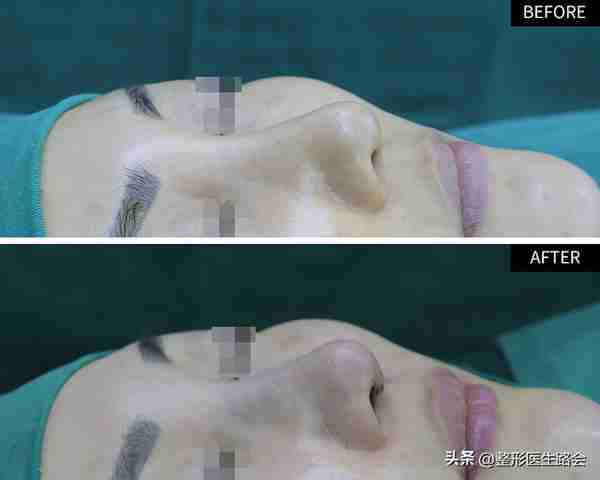 36岁女士隆鼻走弯路,膨体鼻修复+膨体填充鼻基底,6个月后大变样