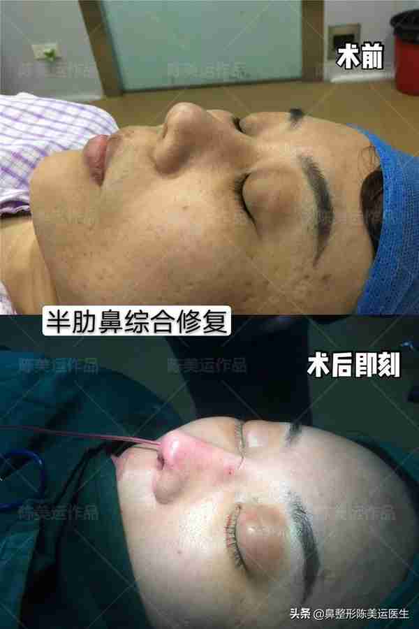 鼻整形术后严重疤痕增生该如何修复?