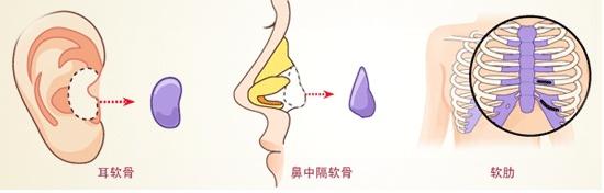 欧式挺隆鼻