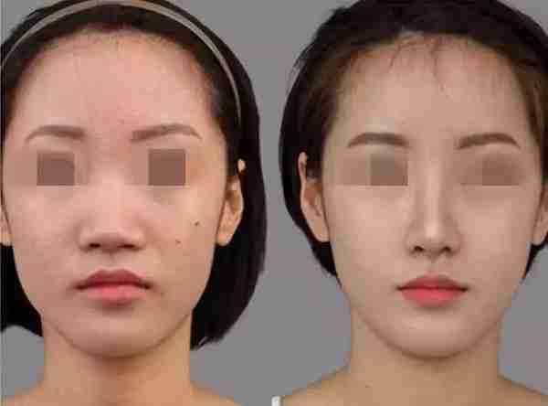 做鼻综合要三万?我只花了50块就拥有了张柏芝同款美鼻!