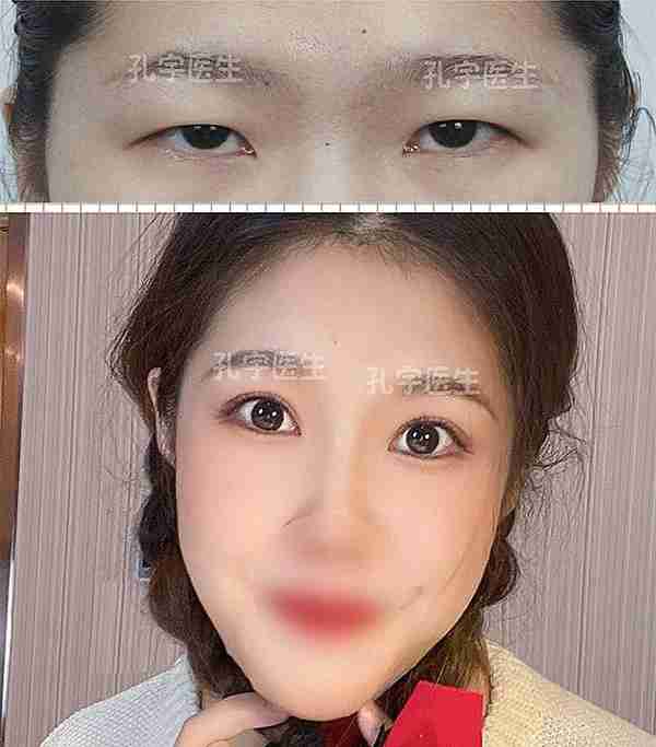 河南姑娘内双肿眼泡明显,我是如何给她设计自然款双眼皮的