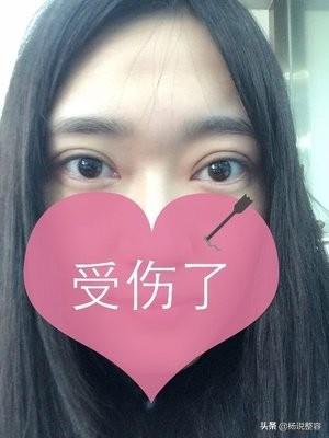 全切双眼皮不是说是永久的吗?为啥会消失呢?