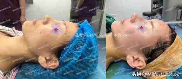 做脂肪填充之后,会下垂得更厉害?更容易显老?准备做面填来看看