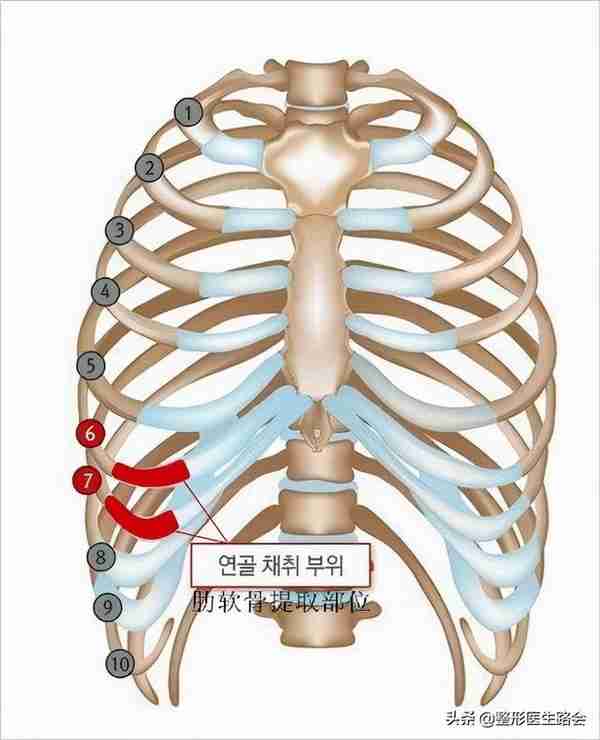 网上大热的肋骨鼻到底怎么样?取肋软骨会对身体有影响吗?