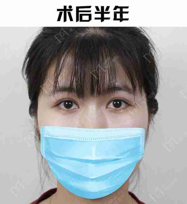 河南姑娘内双肿眼泡明显,我是如何给她设计自然款双眼皮的