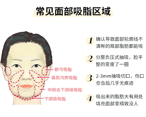 面部吸脂后应该做好哪些护理?
