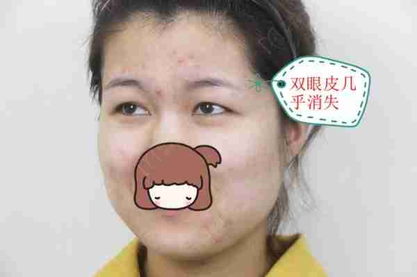 河南姑娘内双肿眼泡明显,我是如何给她设计自然款双眼皮的