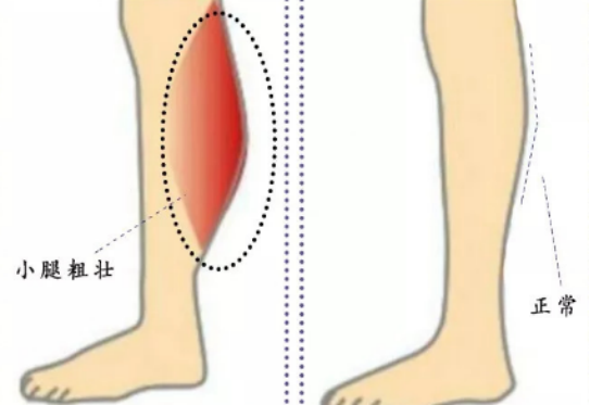 求美需谨慎！深圳一少女打瘦腿针致小腿肌肉挛缩 变长短腿