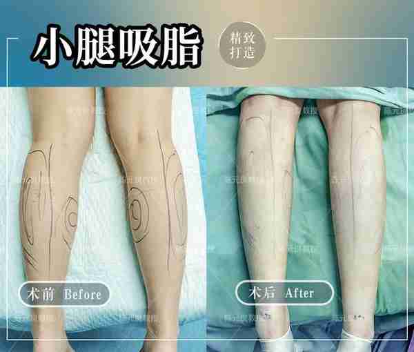 小腿吸脂 | 小腿粗成这样,还有得救吗?