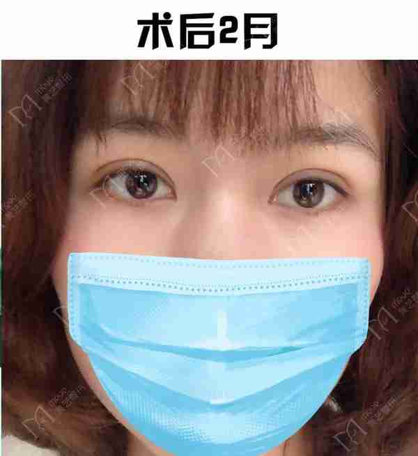 河南姑娘内双肿眼泡明显,我是如何给她设计自然款双眼皮的