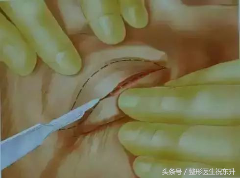 想做全切双眼皮,又担心不安全,有没有人可以给点真实性的建议?