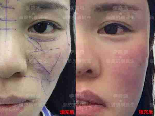 值得收藏!关于自体脂肪填充,那些整形医生不会告诉你的