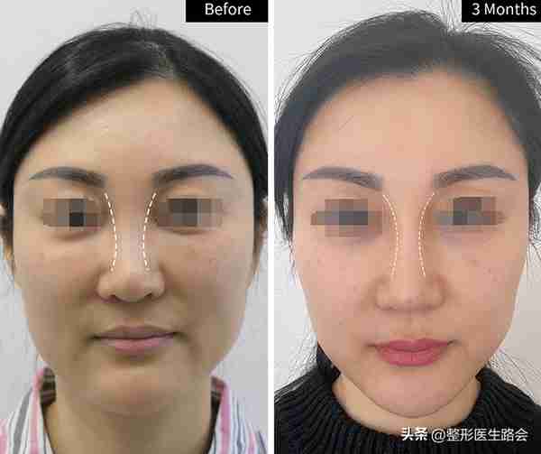 36岁女士隆鼻走弯路,膨体鼻修复+膨体填充鼻基底,6个月后大变样