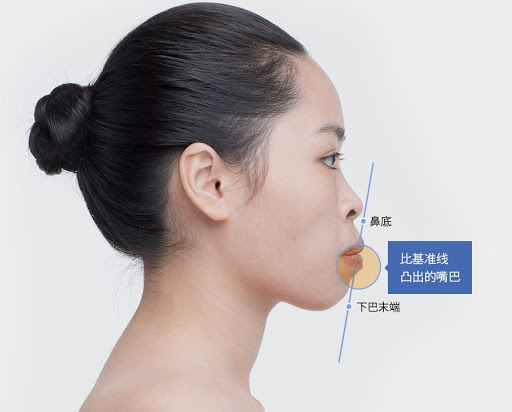 矫正牙齿对脸型的影响大吗?什么样的情况下,脸型改变会更明显?