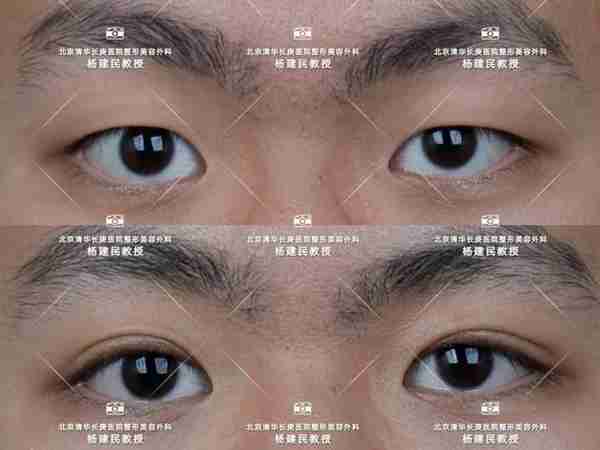 详细了解埋线法双眼皮