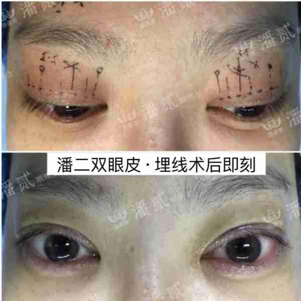 凸眼睛者:眼球突出、上睑凹陷或多层,双眼皮设计为何不宜过宽?