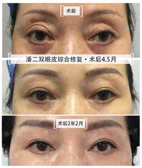 凸眼睛者:眼球突出、上睑凹陷或多层,双眼皮设计为何不宜过宽?