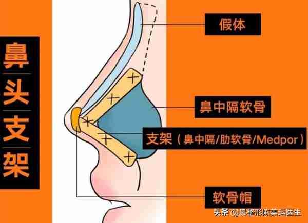 鼻整形术后严重疤痕增生该如何修复?