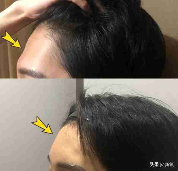 烧到40度会把我的玻尿酸溶掉吗?