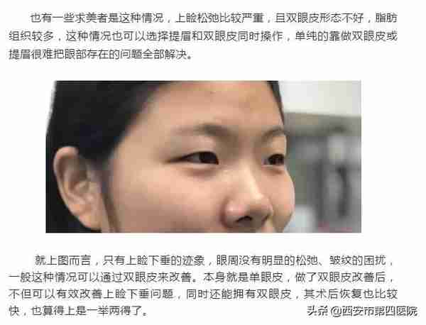 #安心变美课堂##我的安心变美推荐#眼皮松了,做提眉好还是双眼皮好