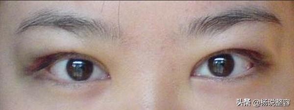 全切双眼皮不是说是永久的吗?为啥会消失呢?