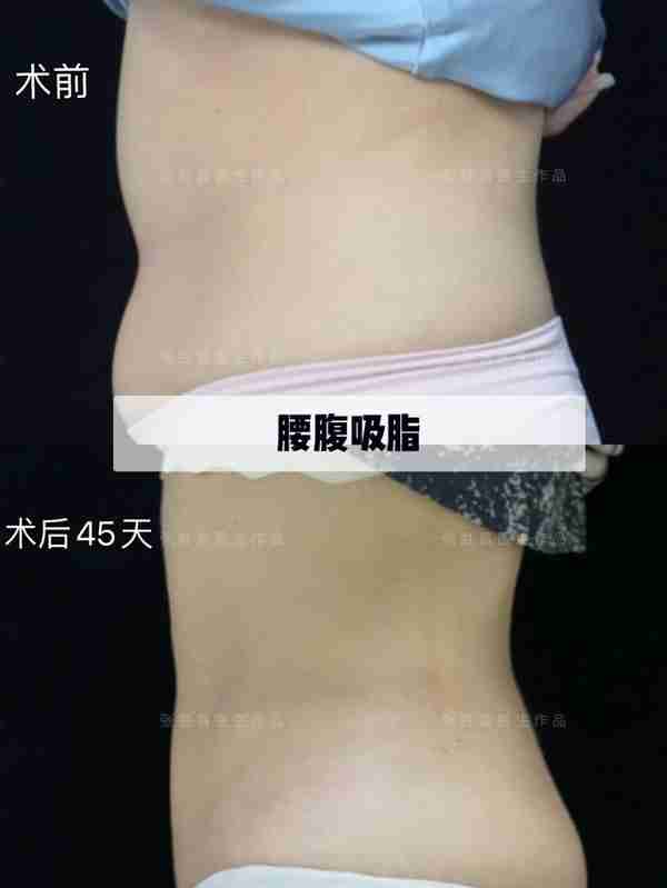 腰腹吸脂术后45天反馈