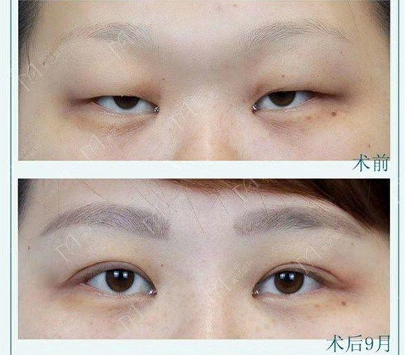 有人割双眼皮颜值大逆袭,而有人割了双眼皮后悔为何反差这样大呢