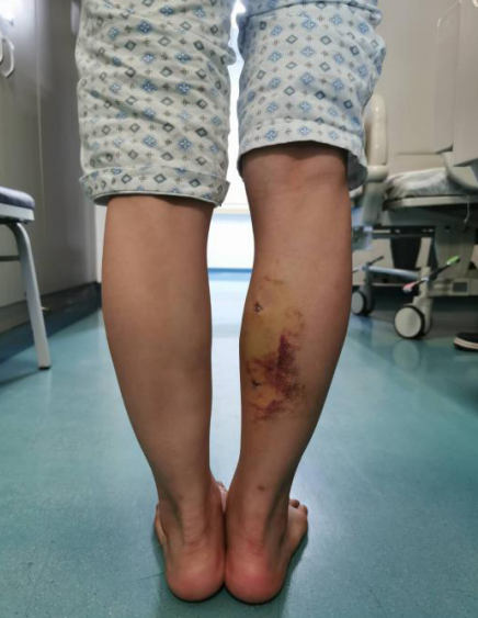 求美需谨慎！深圳一少女打瘦腿针致小腿肌肉挛缩 变长短腿
