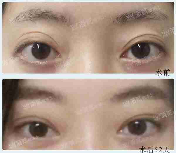凸眼睛者:眼球突出、上睑凹陷或多层,双眼皮设计为何不宜过宽?