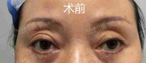 凸眼睛者:眼球突出、上睑凹陷或多层,双眼皮设计为何不宜过宽?