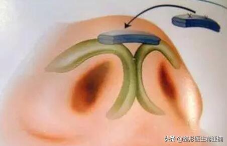 辟谣辟谣 | 耳软骨隆鼻不能做,是真的吗