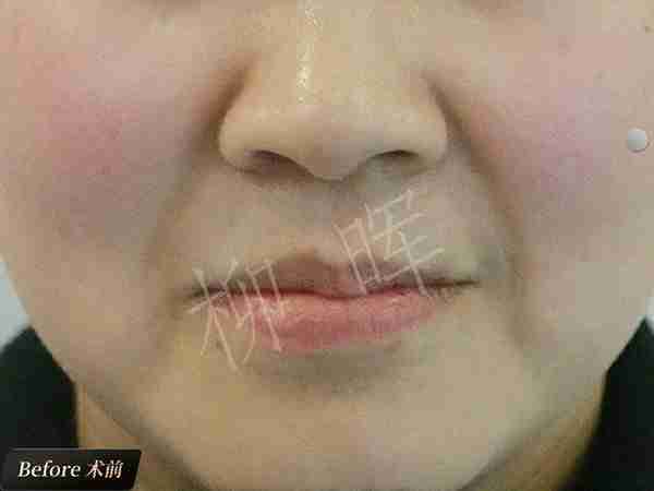 鼻基底凹陷显老态?打了玻尿酸,鼻基底变饱满,立马年轻十岁