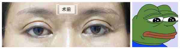 凸眼睛者:眼球突出、上睑凹陷或多层,双眼皮设计为何不宜过宽?