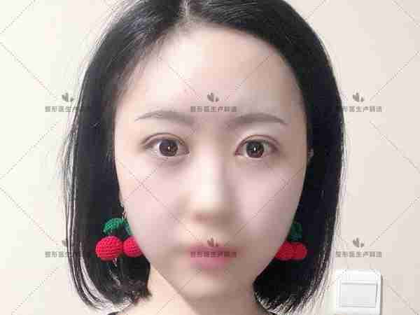 26岁白领割双眼皮,30天后恢复自然,老板直呼像换了个人