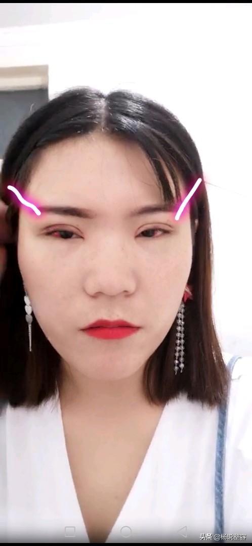 全切双眼皮不是说是永久的吗?为啥会消失呢?