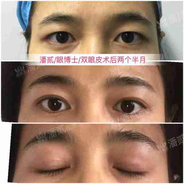 凸眼睛者:眼球突出、上睑凹陷或多层,双眼皮设计为何不宜过宽?