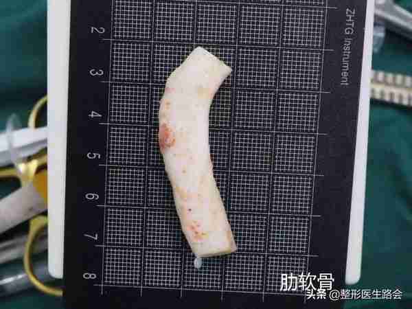 网上大热的肋骨鼻到底怎么样?取肋软骨会对身体有影响吗?
