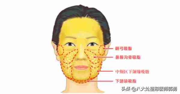 是不是任何一个肥胖部位都可以吸脂呢?