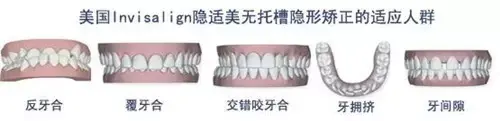 Helen齿科中心——矫正的方法及其优缺点
