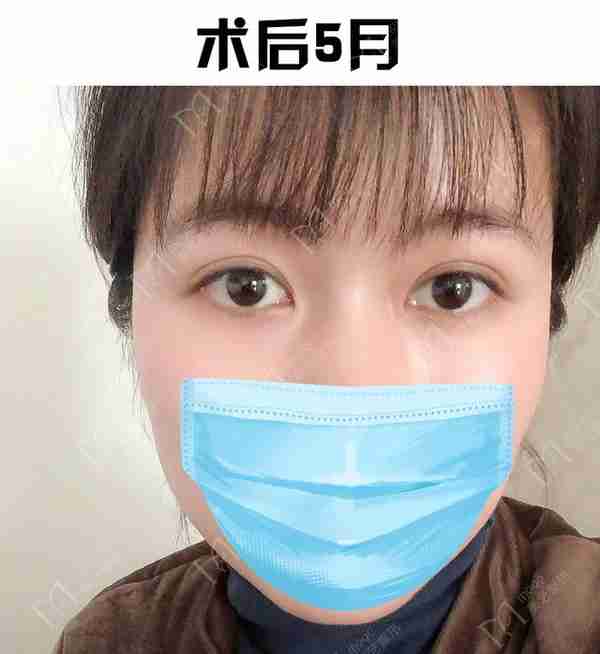 河南姑娘内双肿眼泡明显,我是如何给她设计自然款双眼皮的